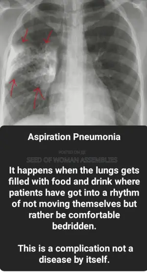Therapy for Aspiration Pneumonia