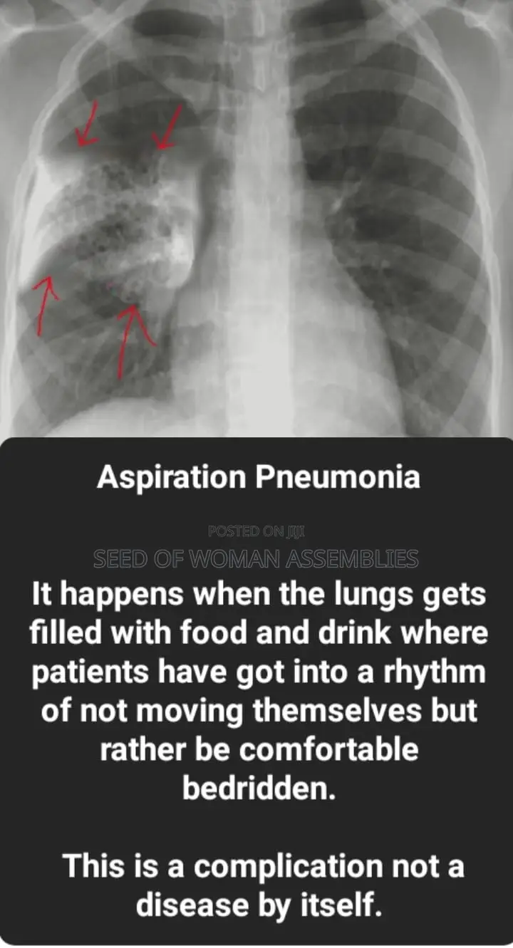 Therapy for Aspiration Pneumonia